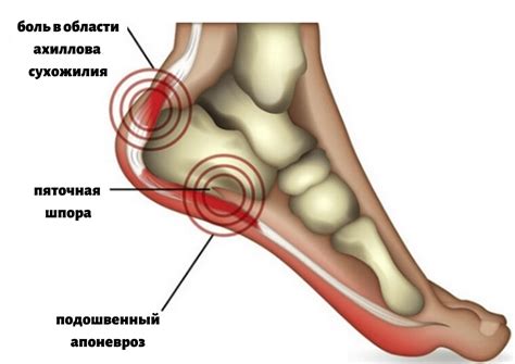 Лечение пяточной шпоры: симптомы, причины, классификация, диагностика ...