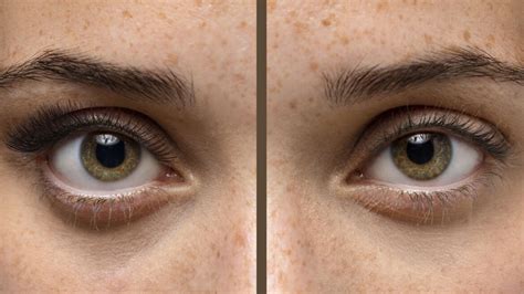 depigmentation therapy lanaoncospa