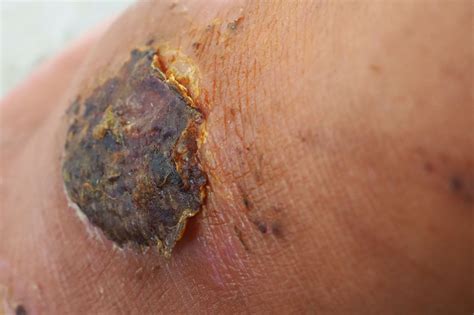 Wounds Heal Faster When—Covered? - Common Reader