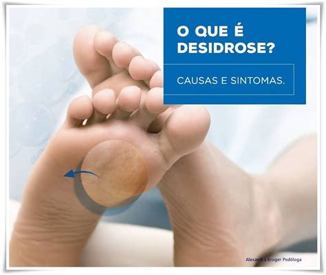 O Que É Disidrose Nos Pés - Alexandra - BOLHA NOS PÉS? PODE SER DESIDROSE. Disidrose são pequenas ...