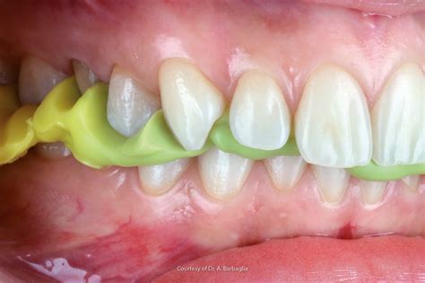 bite registration  occlusal rim  michael brehm blog