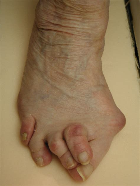 Hammertoes and Bunions (Hallux Valgus, HAV) — Davis Shoe Therapeutics