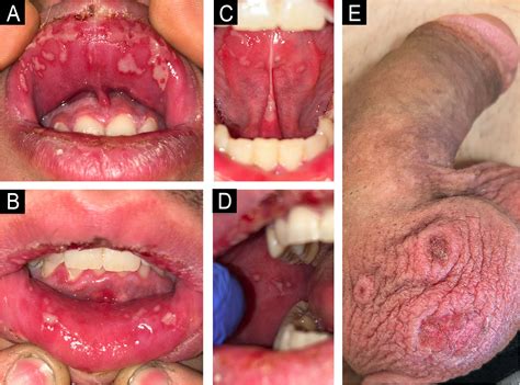 Mycoplasma-Induced Rash and Mucositis (MIRM) mimicking herpetic stomatitis
