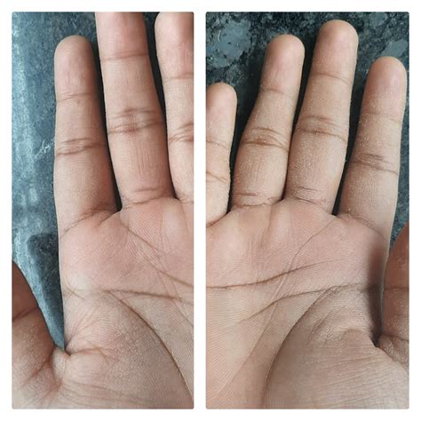 Skin on my palm has started peeling. I don't have any burning sensation
