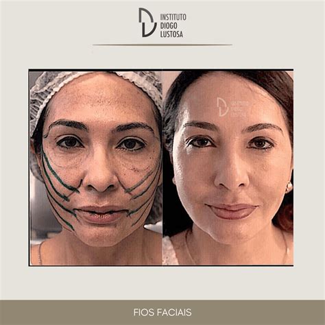 Fios De Pdo Antes E Depois Bigode Chinês