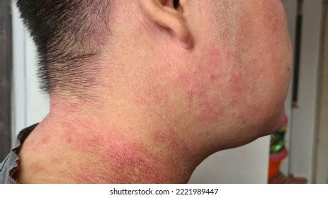 atopic dermatitis eczema eksim bahasa  stock photo