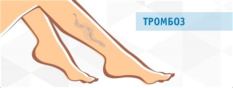 Лечение тромбоза глубоких вен нижних конечностей