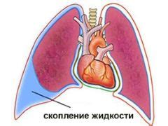 Что такое гидроторакс?