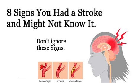 how to know if you have had a stroke
