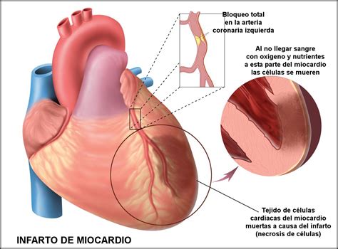¿ Prevención de Infarto Agudo al Miocardio ? — Steemit