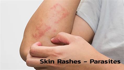 Skin Rashes – Parasites | Uateka.com