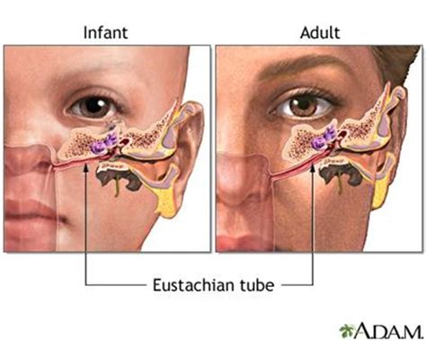Eustachian Tube Dysfunction in Southwest Ohio - Southwest Ohio ENT ...