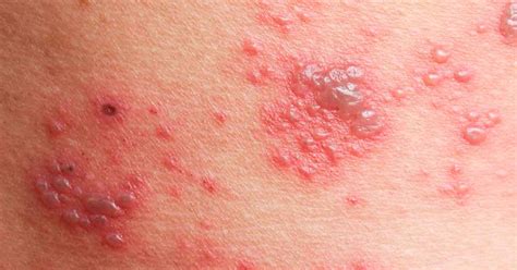 shingles   painful rash lumby valley times