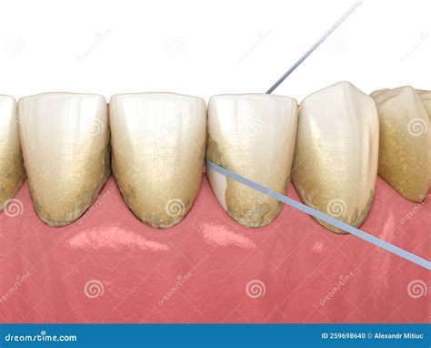 oral hygiene  dental floss  plaque removing medically