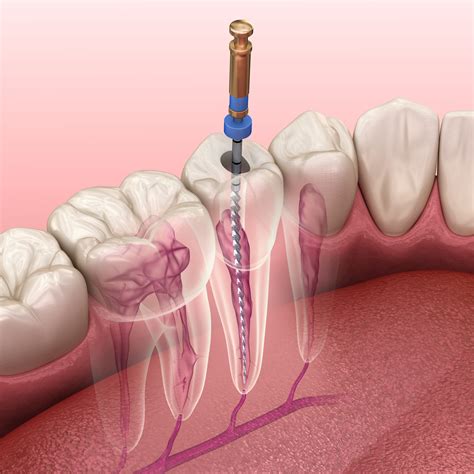 Root Canal Therapy – Maple Ridge Endodontics