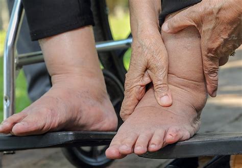 How Do You Stop Diabetic Feet from Itching?