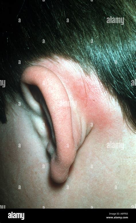 mastoiditis
