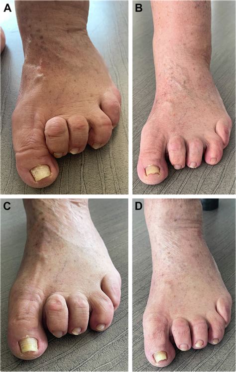Toes Deformities in Cavovarus - Foot and Ankle Clinics