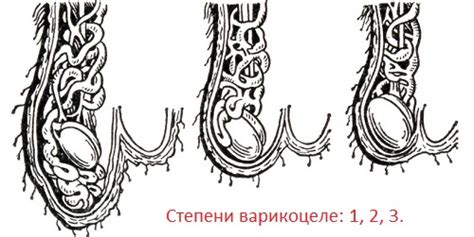 Варикоцеле: фото, симптомы, лечение, причины