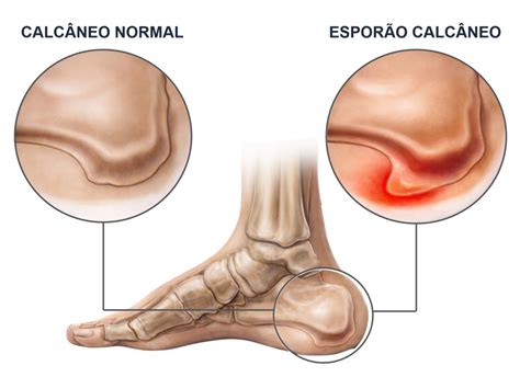 O Que É Esporão Calcâneo - Esporão calcâneo: Causas, sintomas e tratamentos - Avantefisio
