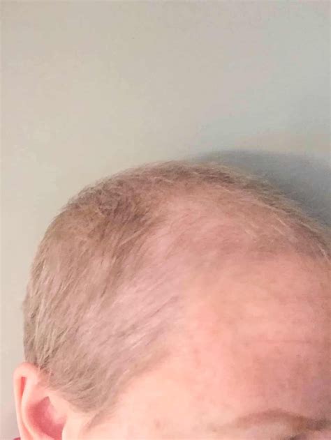 Hair growth after chemo timeline with monthly pictures – Artofit