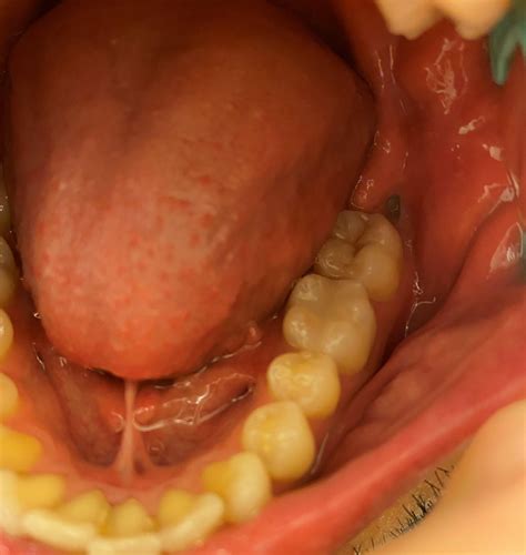 What is causing this pain in my mouth? : r/Dentistry