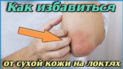 Что делать если СУХАЯ КОЖА НА ЛОКТЯХ Полезные советы по уходу за ...