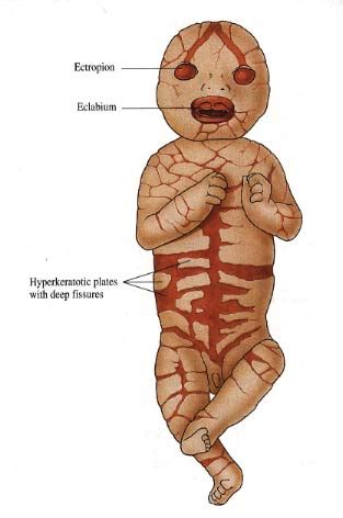 Harlequin Ichthyosis | IBG News