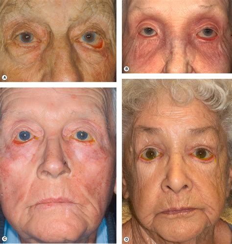 Diagnosis and Treatment of Ectropion - Clinical Tree