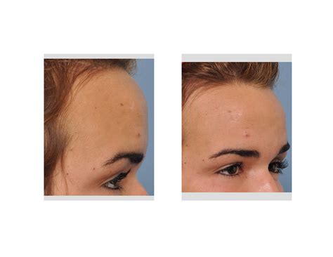 Experts explain what causes a massive forehead in some adults 6