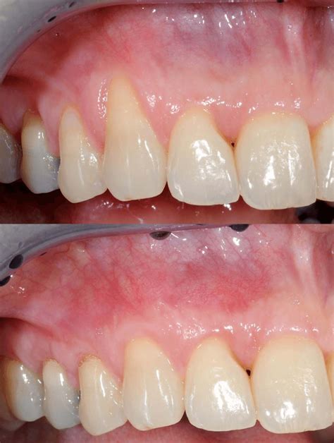 Gum Grafting - Missoula, MT - Montana Dental Arts