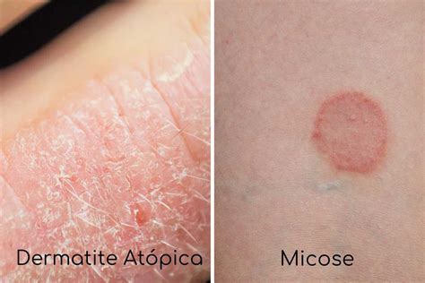 dermatite atopica    sintomas causas  tratamento cliniguia