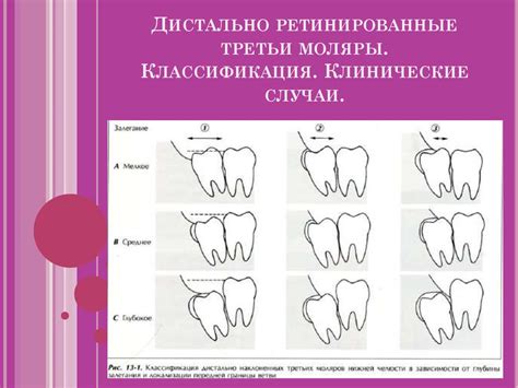 Удаление третьих моляров верхней и нижней челюсти. Ретенция и дистопия ...