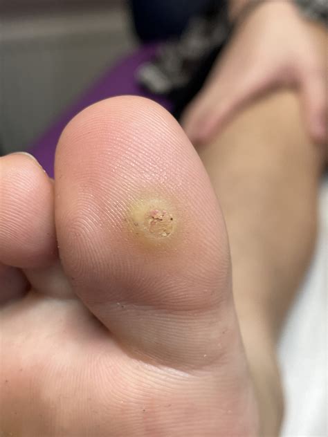 P5 verruca initial | A&A Podiatrists & Chiropodists