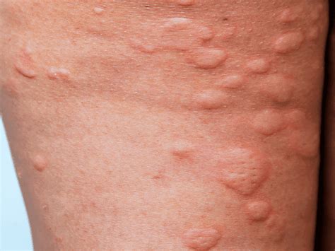 itchy hives  night  keith herrera blog