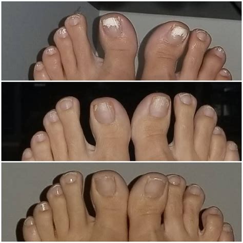 Pentachom Antifungal Laser System | Advanced Nail Fungus Treatment