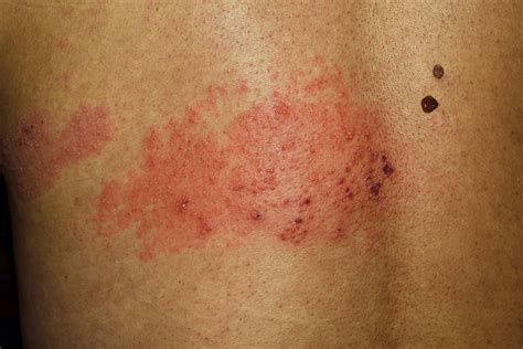 stages  shingles virtuwell