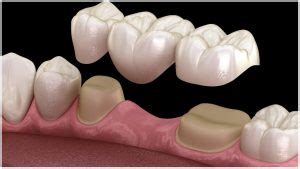 fixed dental prosthesis types advantages el shenawy dental center