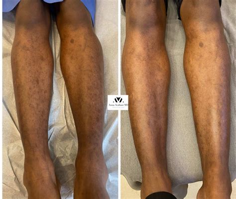 Leg Skin Discoloration Brown Spot