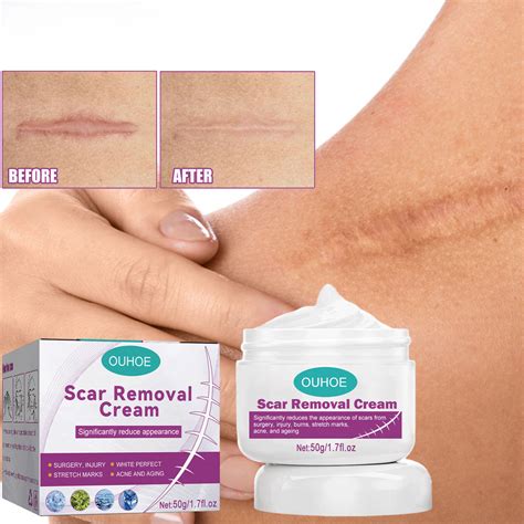 Creme Para Cicatriz De Cirurgia - Creme De Gel Para Cicatrizes , Avançado Cirúrgico Seção Cirúrgica ...