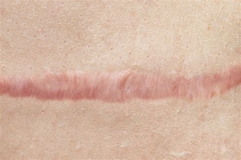reduce  lighten scars   aesthetic experts