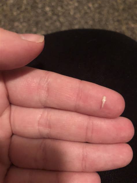 Ingrown toenail sans blood and pus : r/popping