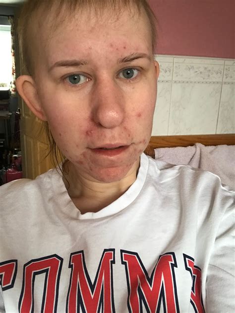 Lucy Alana: Before and After Roaccutane