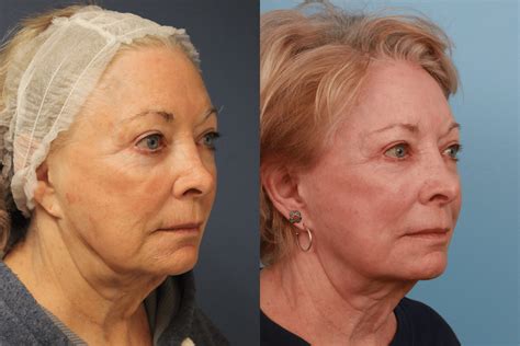 Laser Treatments & Skin Care | FacesFirst Cosmetic Surgery