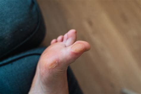 how to take care of foot blisters
