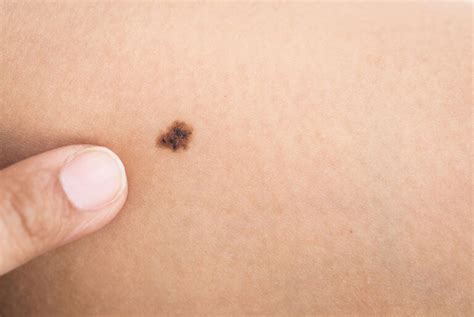 early stage pictures of cancerous moles | Symptoms and pictures