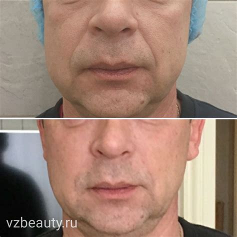 Носогубные складки — vzbeauty.ru