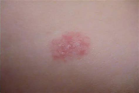 red spots    skin healthy food