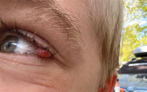 Implications of missed foreign bodies under the upper eyelid | Eye News
