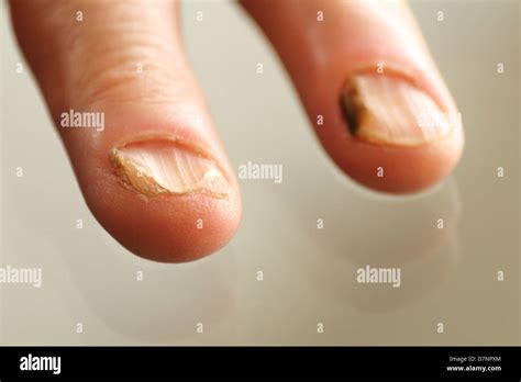 Mycose Des Ongles Banque d'image et photos - Alamy
